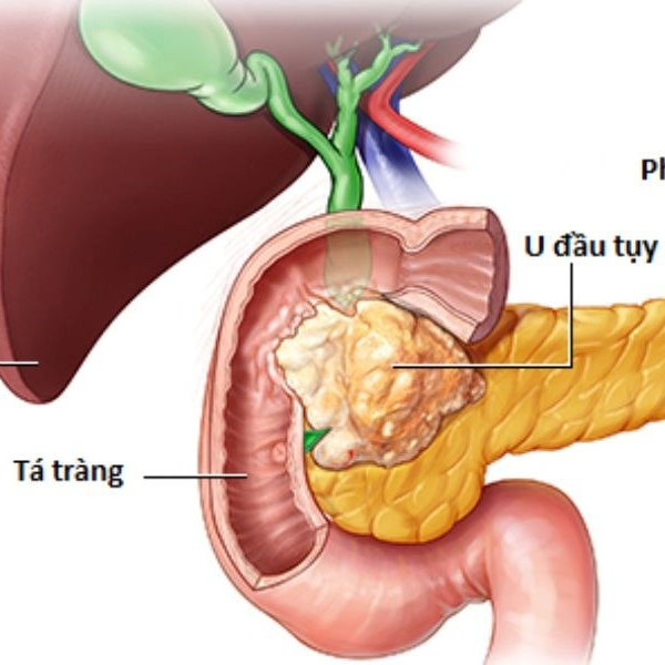 Bệnh nhân ung thư tuyến tụy sống được bao lâu?