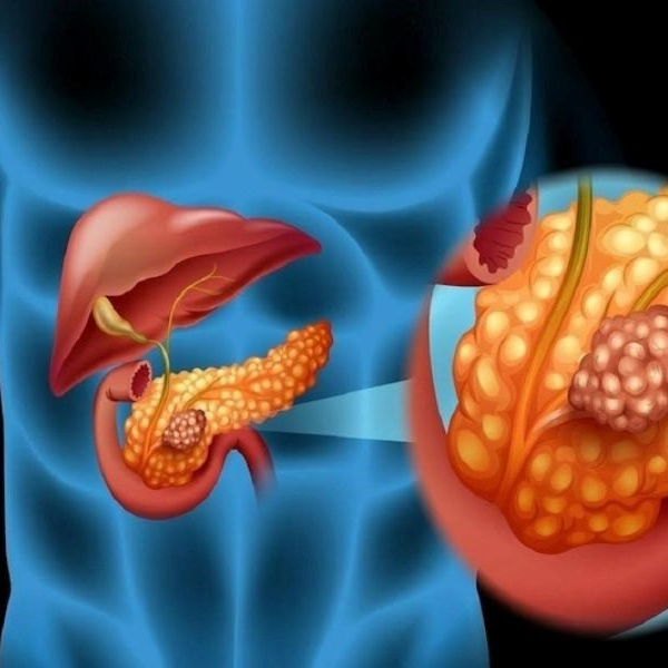 [Giải đáp] Căn bệnh ung thư tuyến tụy có chữa được không?