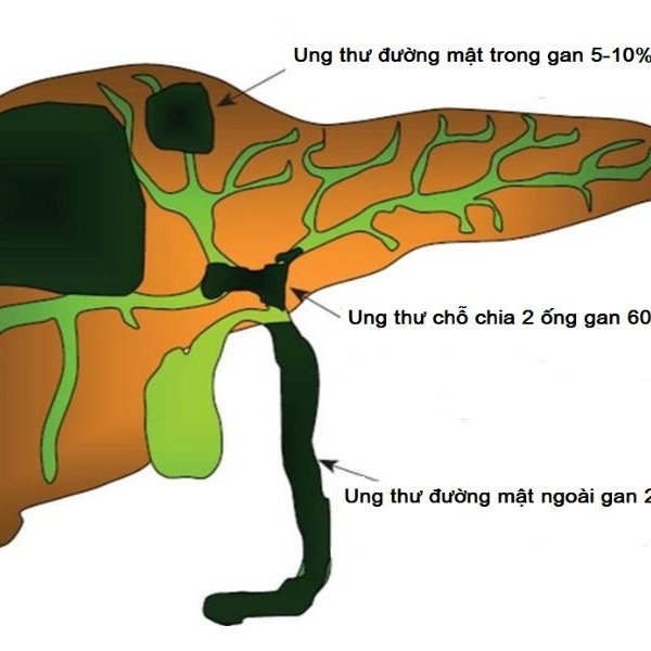 Ung thư đường mật và những điều bạn cần biết