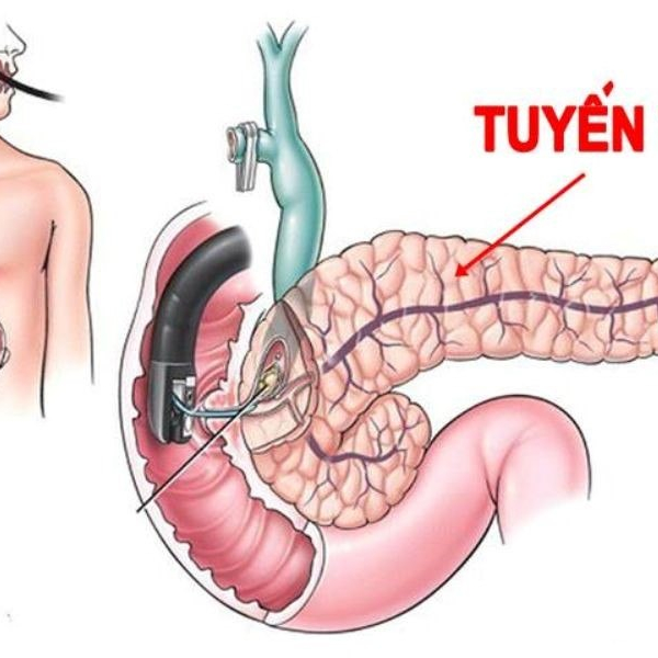 Ung thư tuyến tụy di căn gan và những điều bạn cần biết