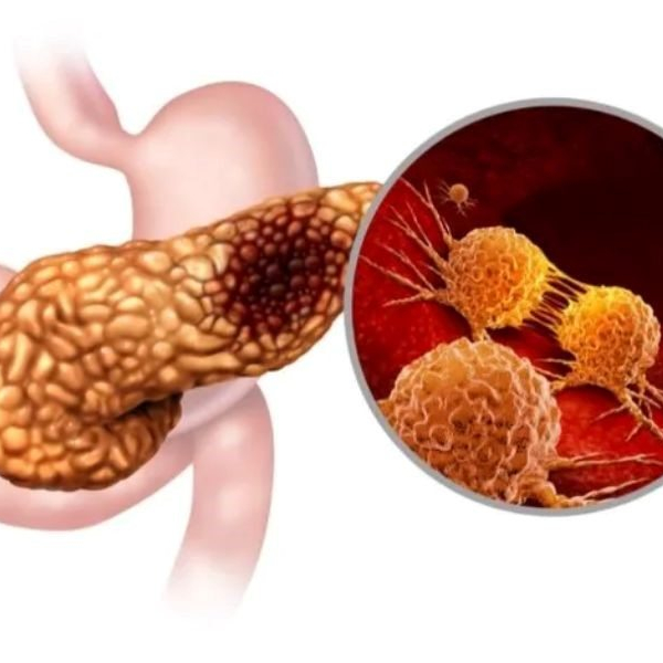 Ung thư tuyến tụy giai đoạn 3 và những điều bạn cần biết