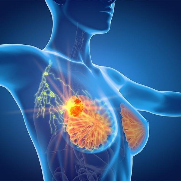 Ung thư vú có di truyền không? - Thắc mắc của rất nhiều người